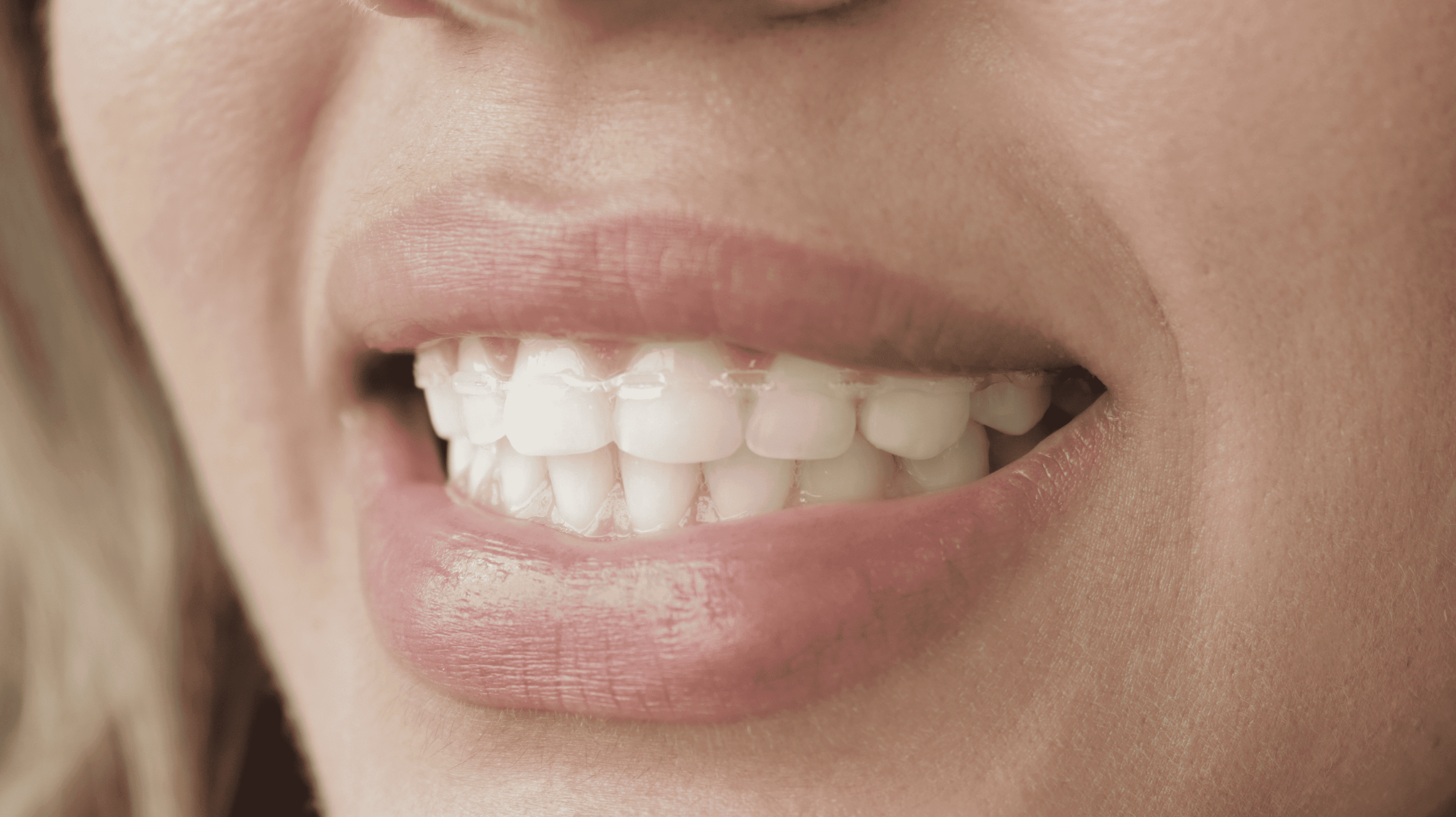 Before Lentes Cerámicos Naturales 