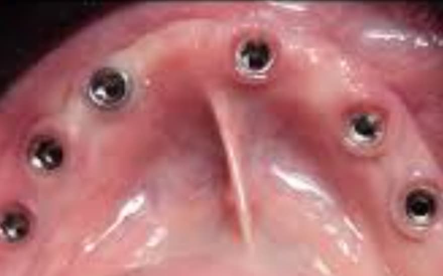 Before Implants with hybrid prosthesis