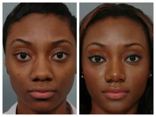 rinoplastia étnica