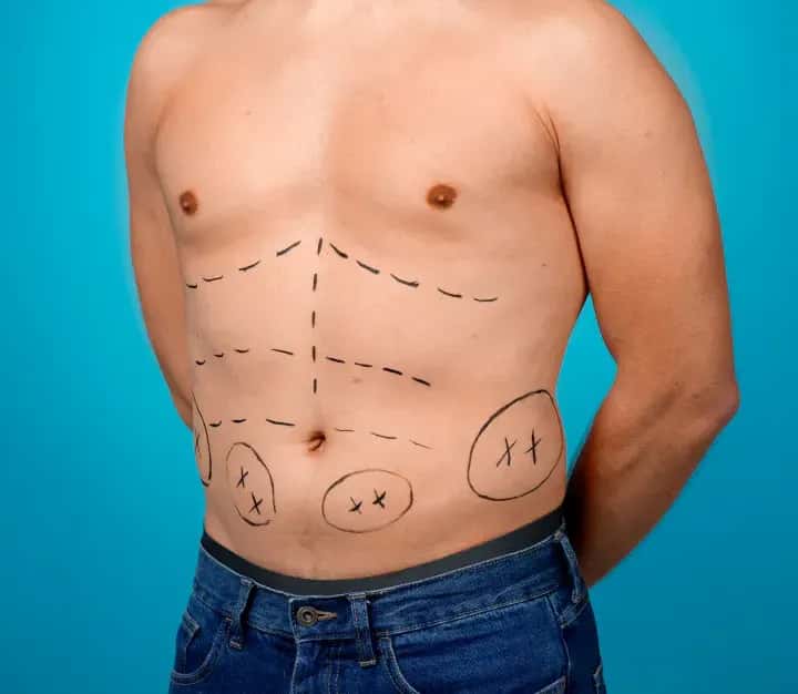Mini Tummy Tuck Candidates: Are You a Good Fit?