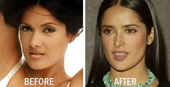 rinoplastia étnica