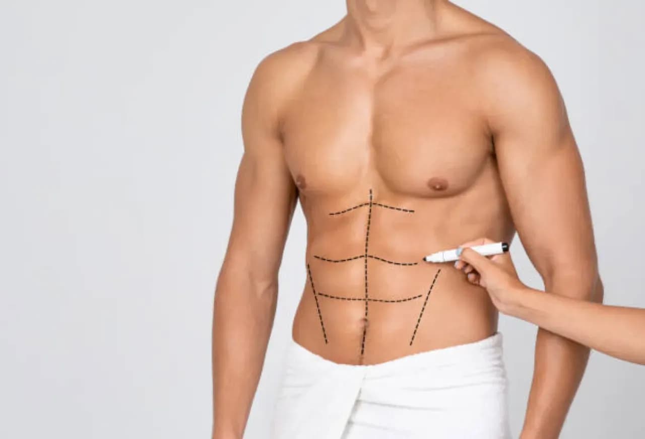 Liposucción para hombre: qué es y cómo se hace