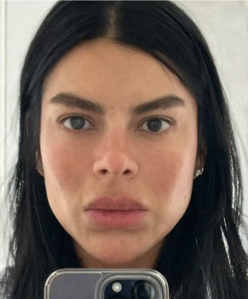 After Armonización facial