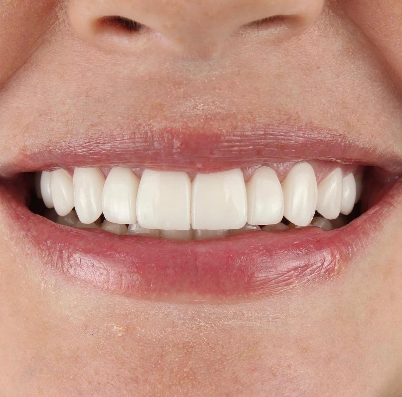 After carillas dentales en cerámica