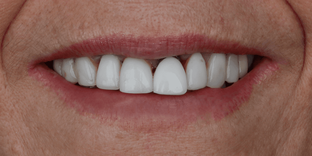 Before Implante dental en zona estética