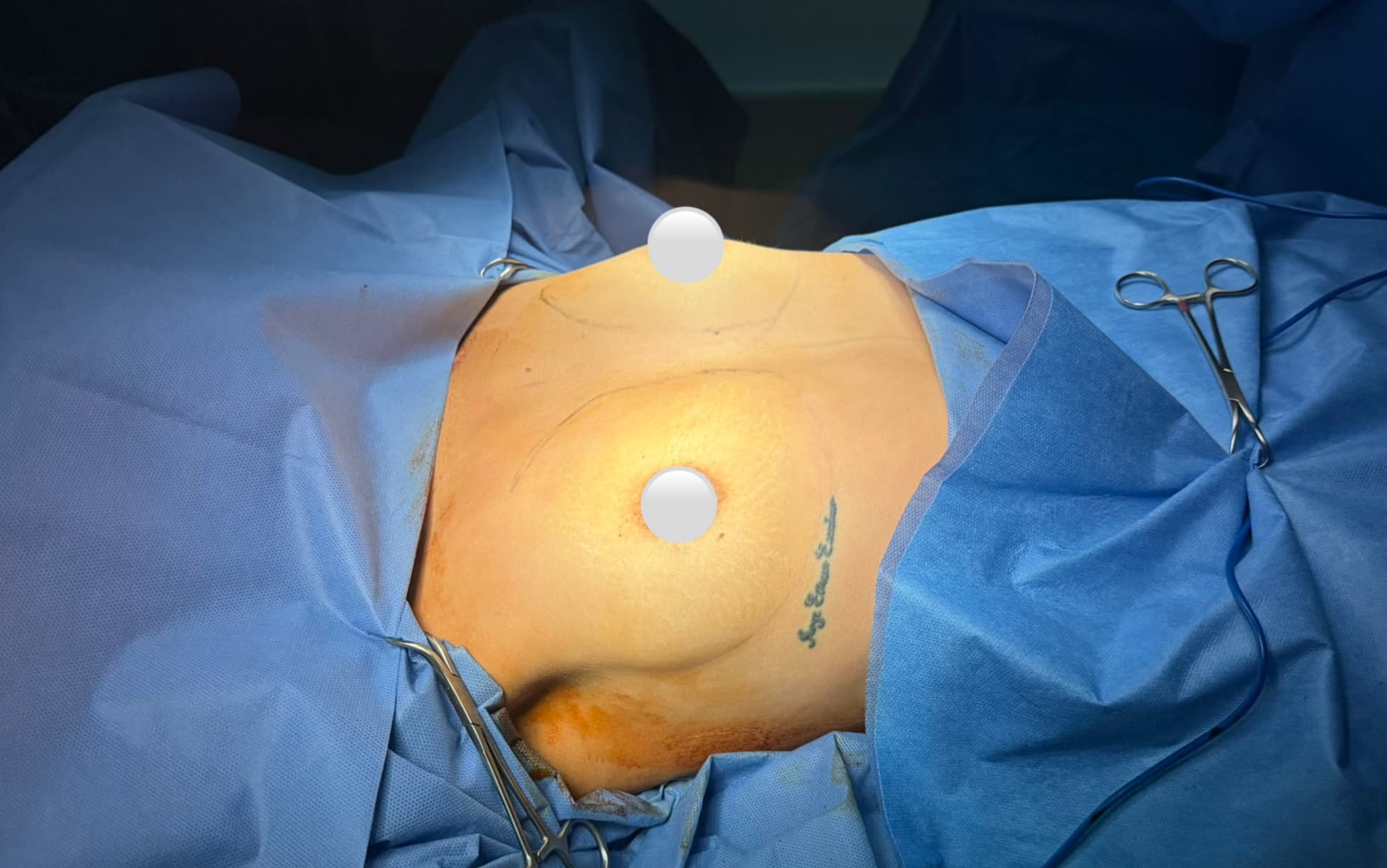 Before Augmentation mammaplasty