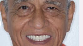 After Implantes dentales