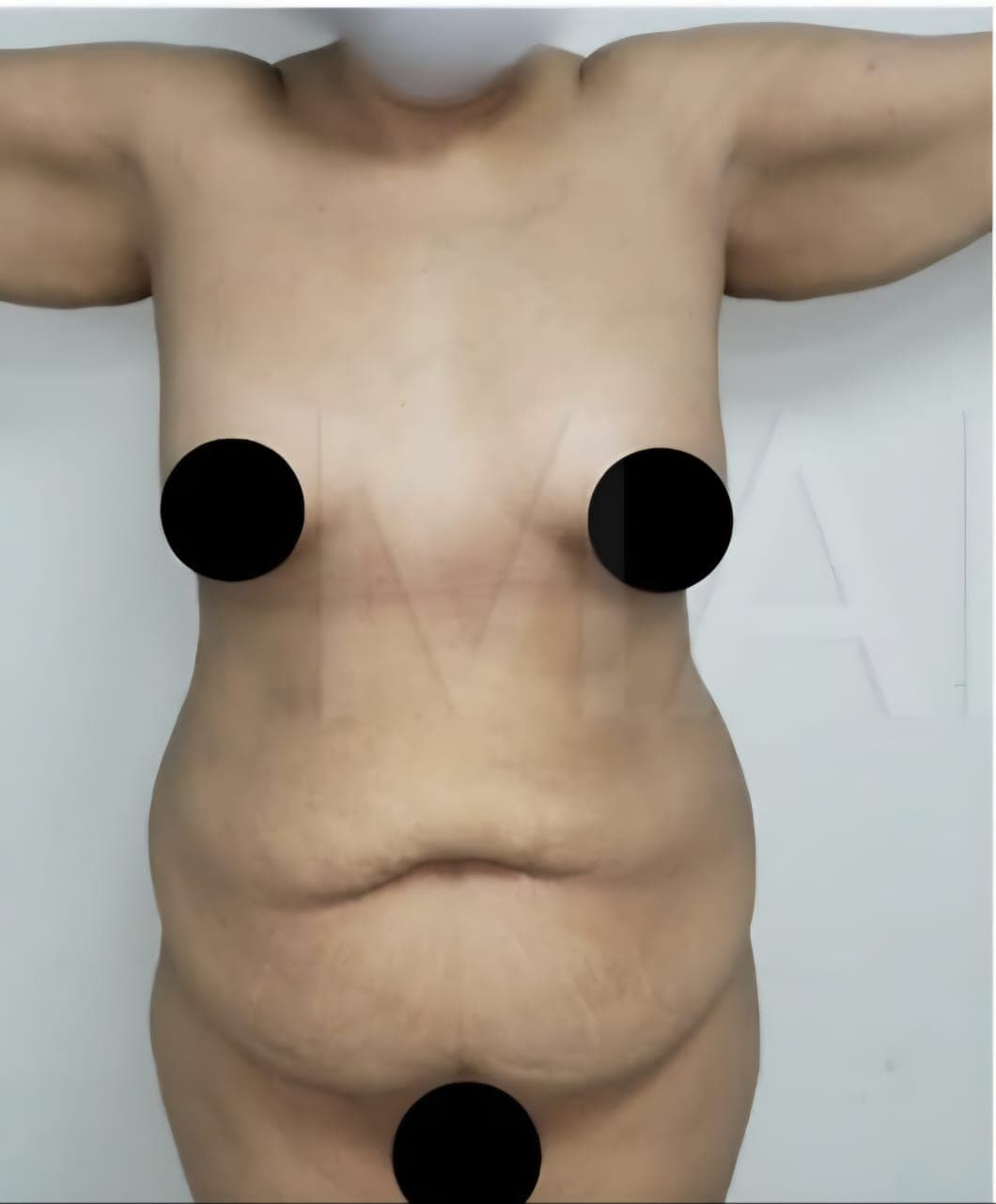 Before Abdominoplastia (tummy tuck)