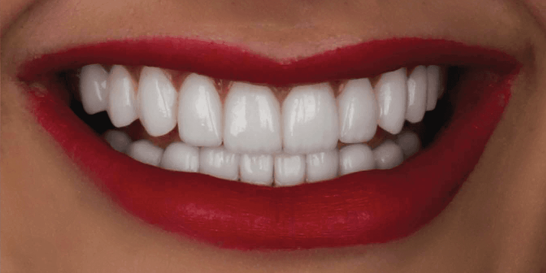 After Diseño de sonrisa en Cerámica