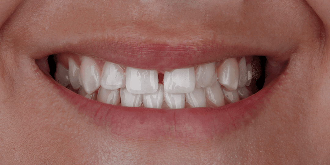 Before Implantes dentales en zona estética + Diseño de sonrisa en cerámica