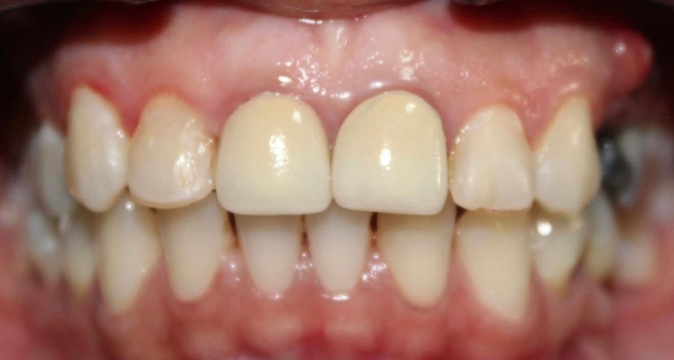 Before carillas dentales en cerámica