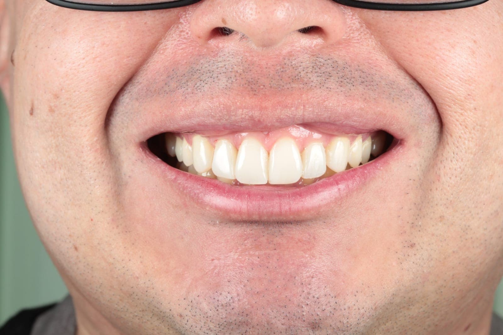 After Microdiseño en resina de alta estética