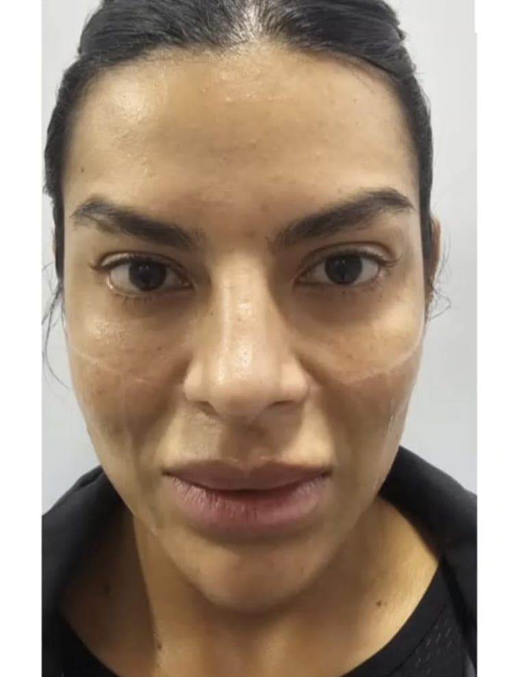 Before Armonización facial