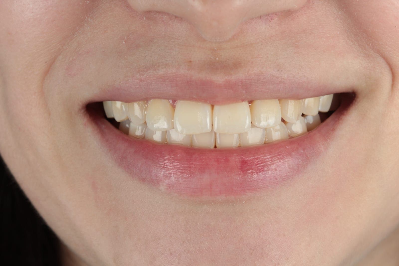 After Ortodoncia de autoligado