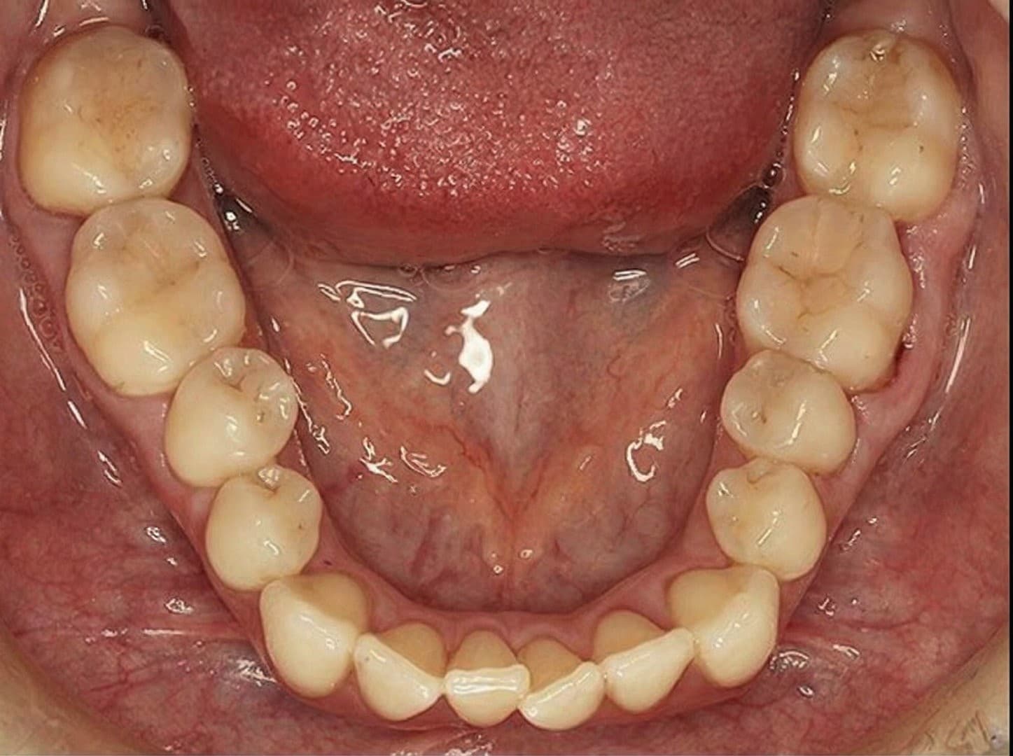 Before Invisalign, 6 meses.