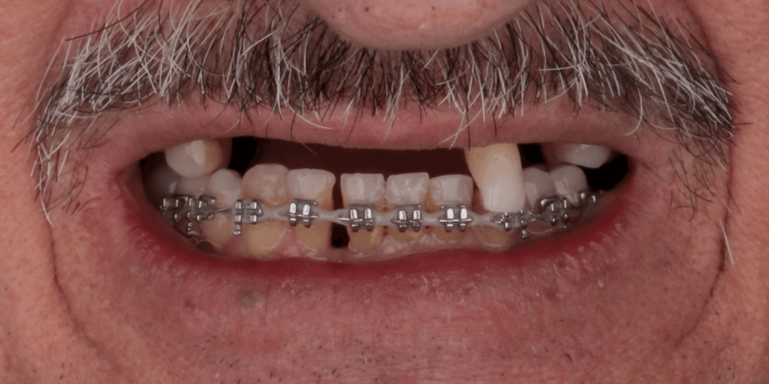 Before Prótesis híbrida superior