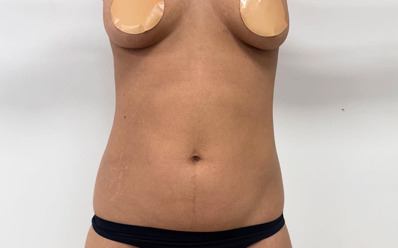 Before Liposuction plus breast augmentation