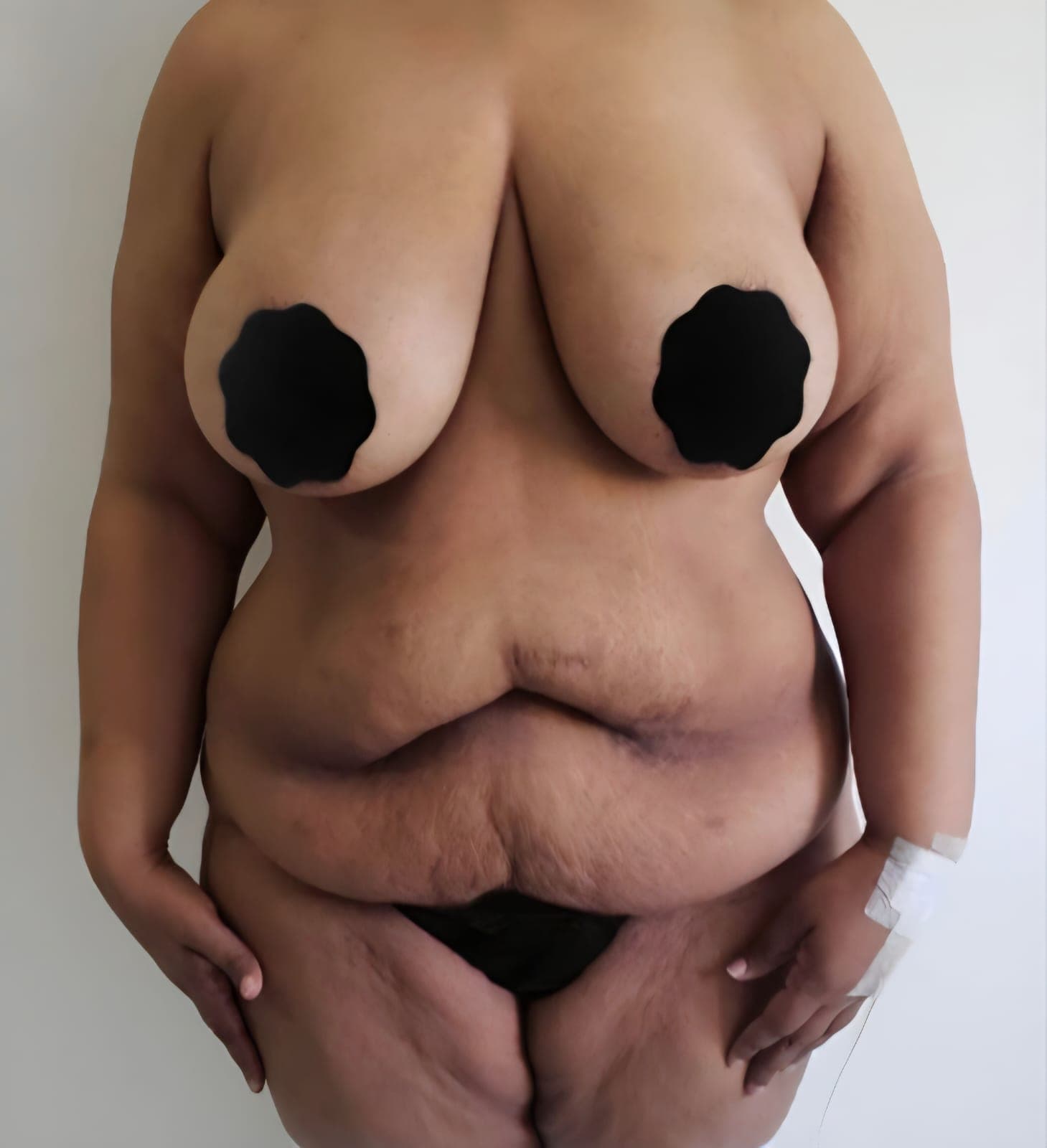 Before Abdominoplastia (tummy tuck)