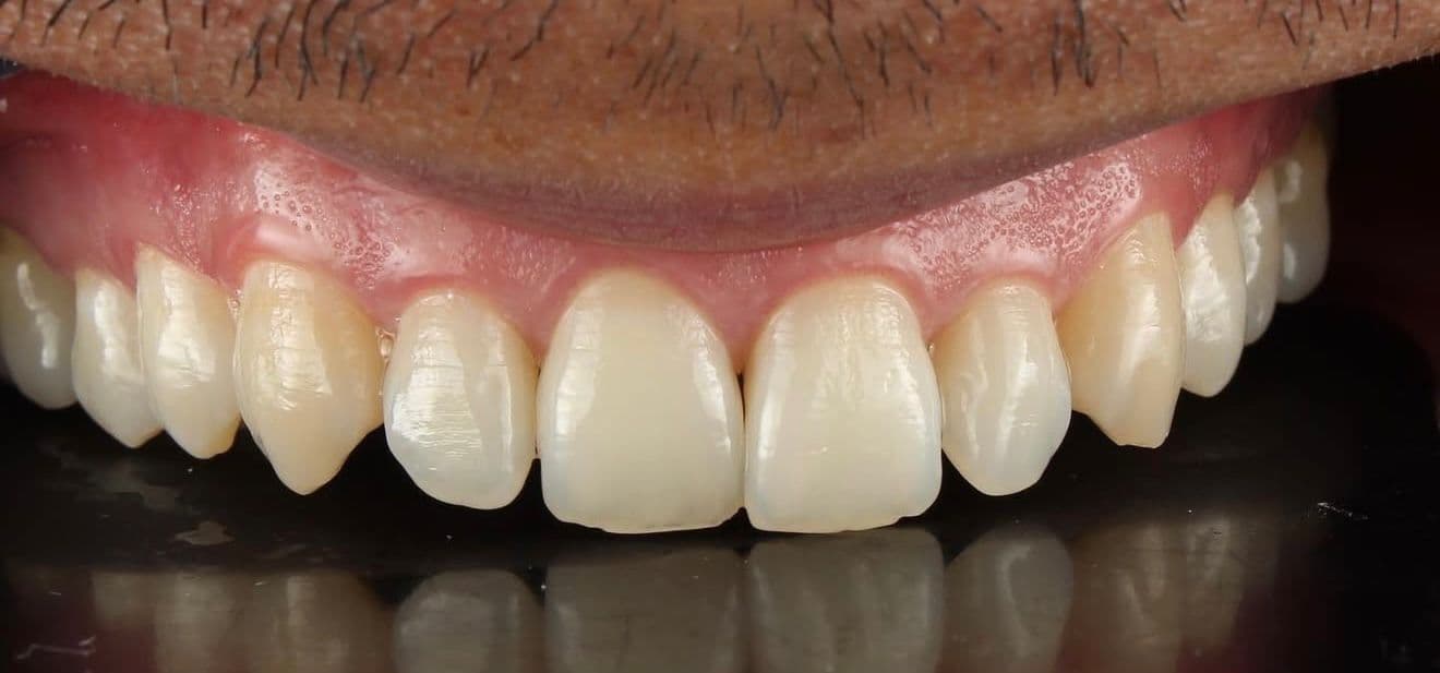 Before carillas dentales en cerámica