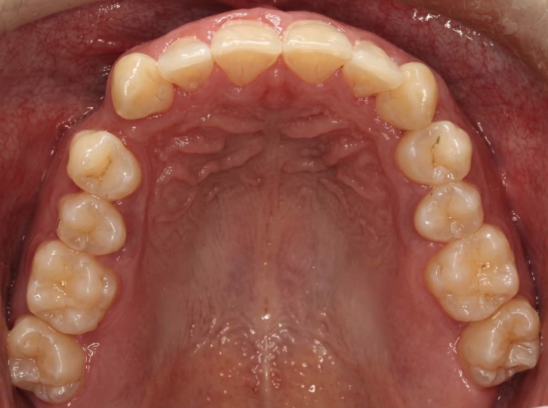 Before Invisalign, 1 año de tratamiento