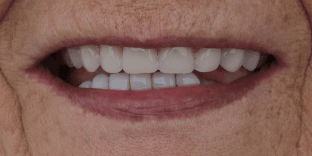 After Prótesis híbrida superior