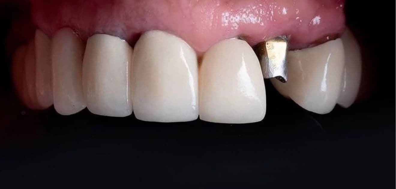 Before carillas dentales en cerámica e implante