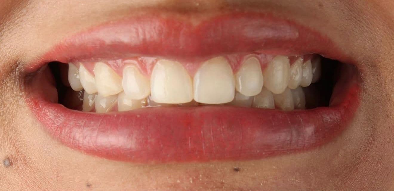 Before carillas dentales en cerámica