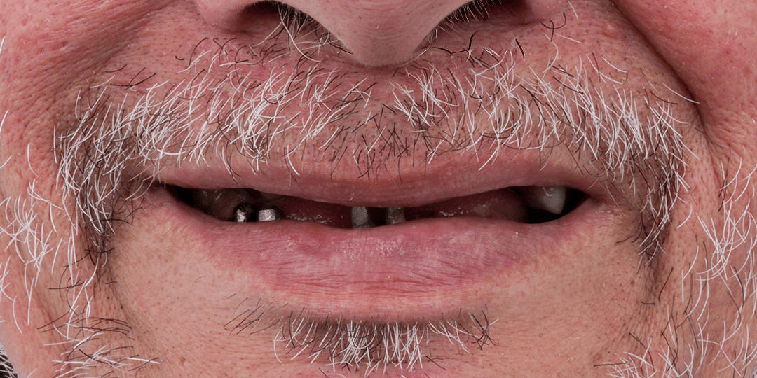 Before Prótesis híbrida bimaxilar