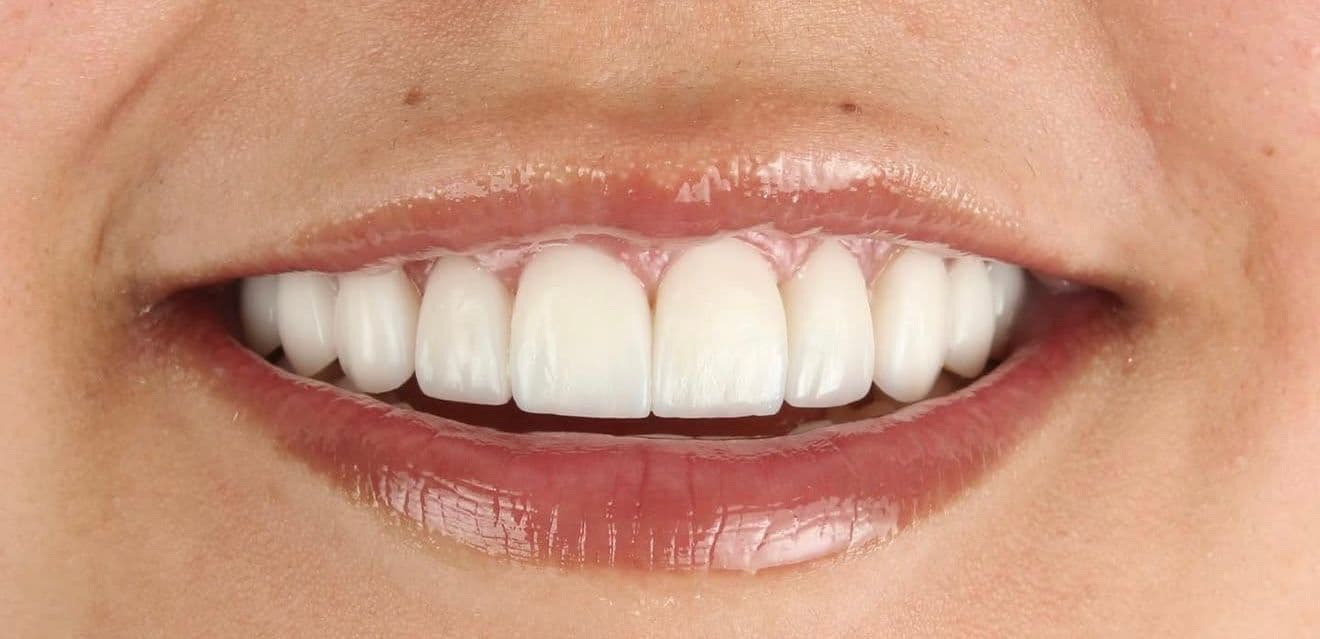 After carillas dentales en cerámica