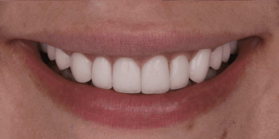 After Diseño de Sonrisa en Cerámica