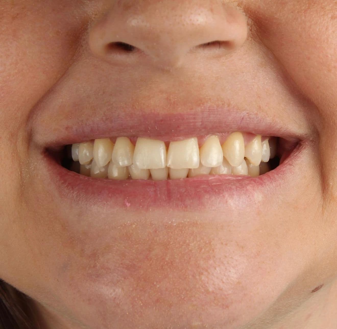 Before carillas dentales en cerámica