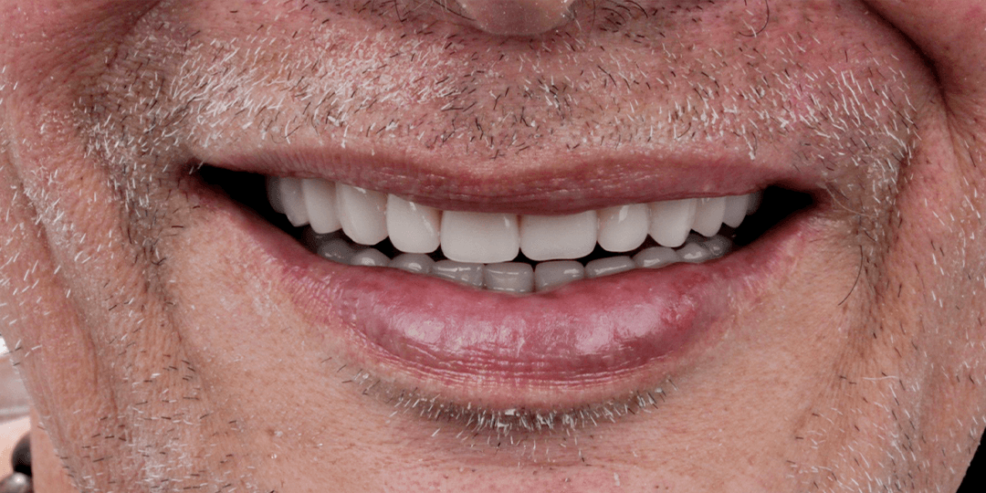 After Prótesis híbrida bimaxilar