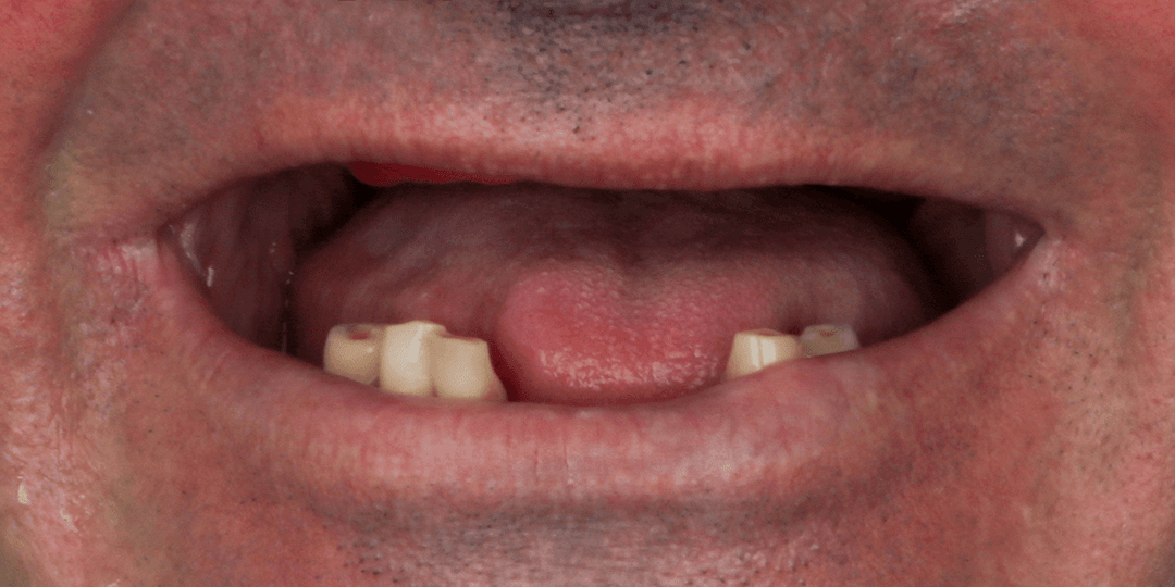 Before Prótesis híbrida bimaxilar