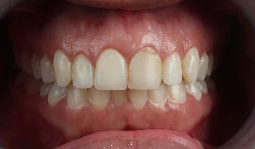 Before carillas dentales en cerámica