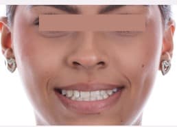 After Ortodoncia Invisible