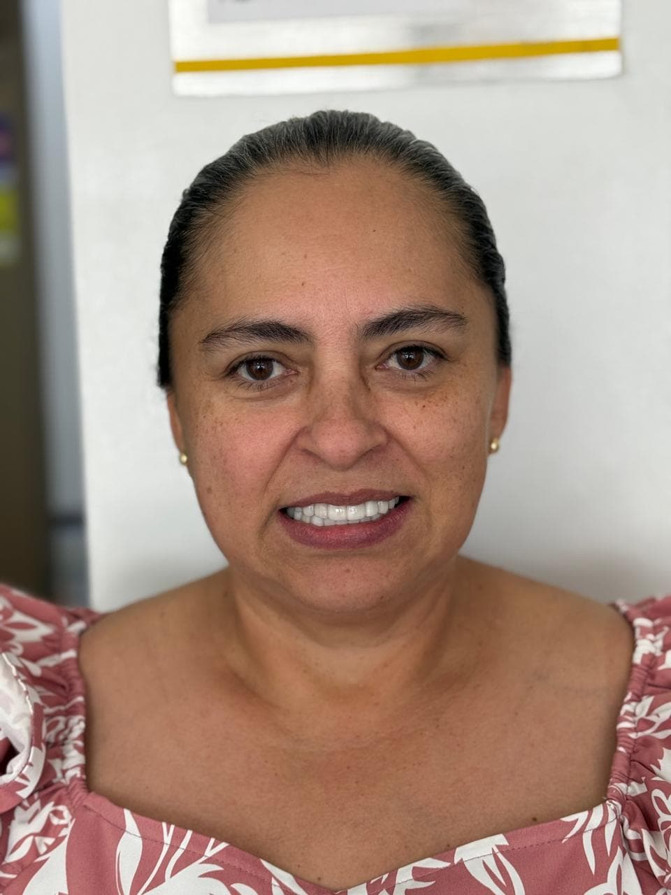 After LENTES CERAMICOS