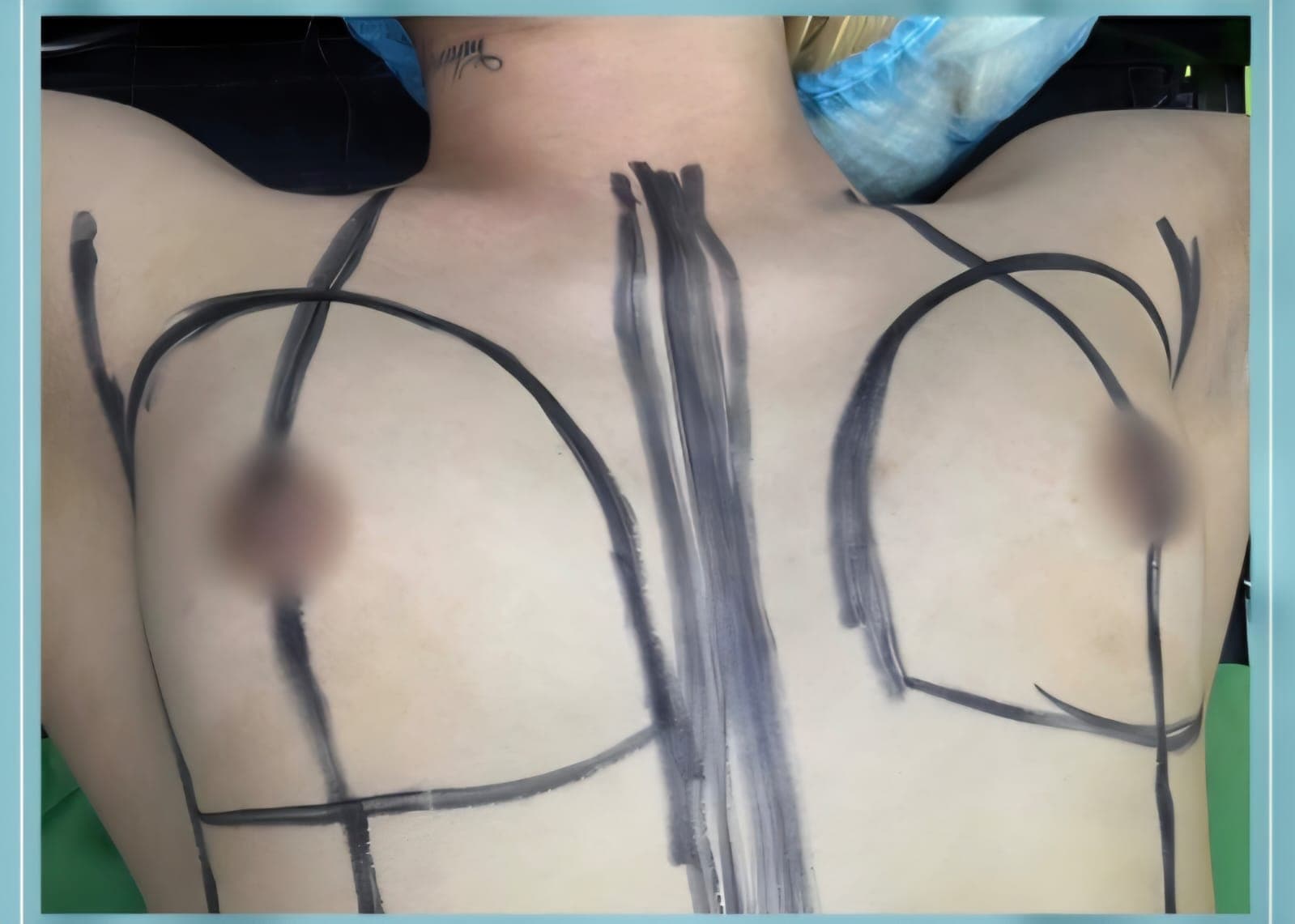 Before Aumento de senos con implantes