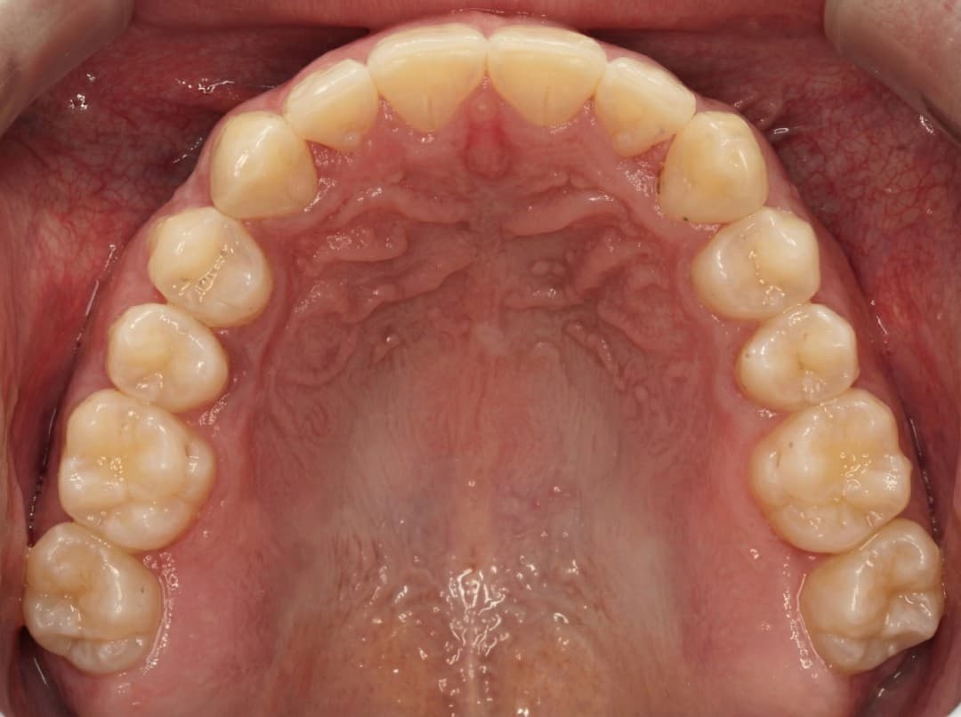 After Invisalign, 1 año de tratamiento