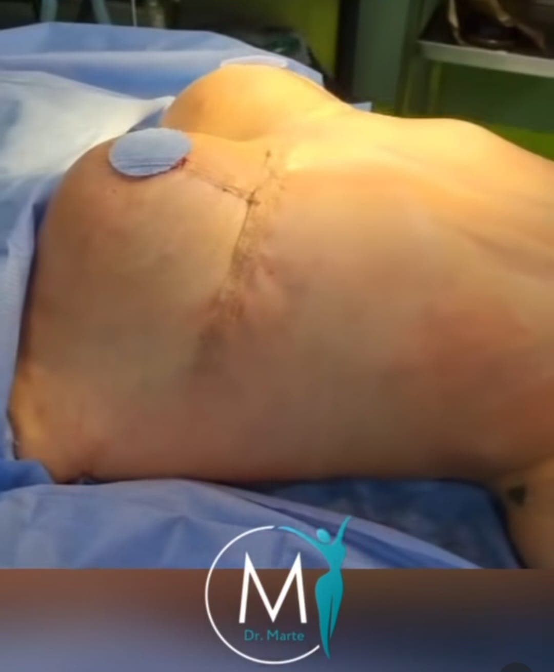 After Reconstrucción de senos con implantes