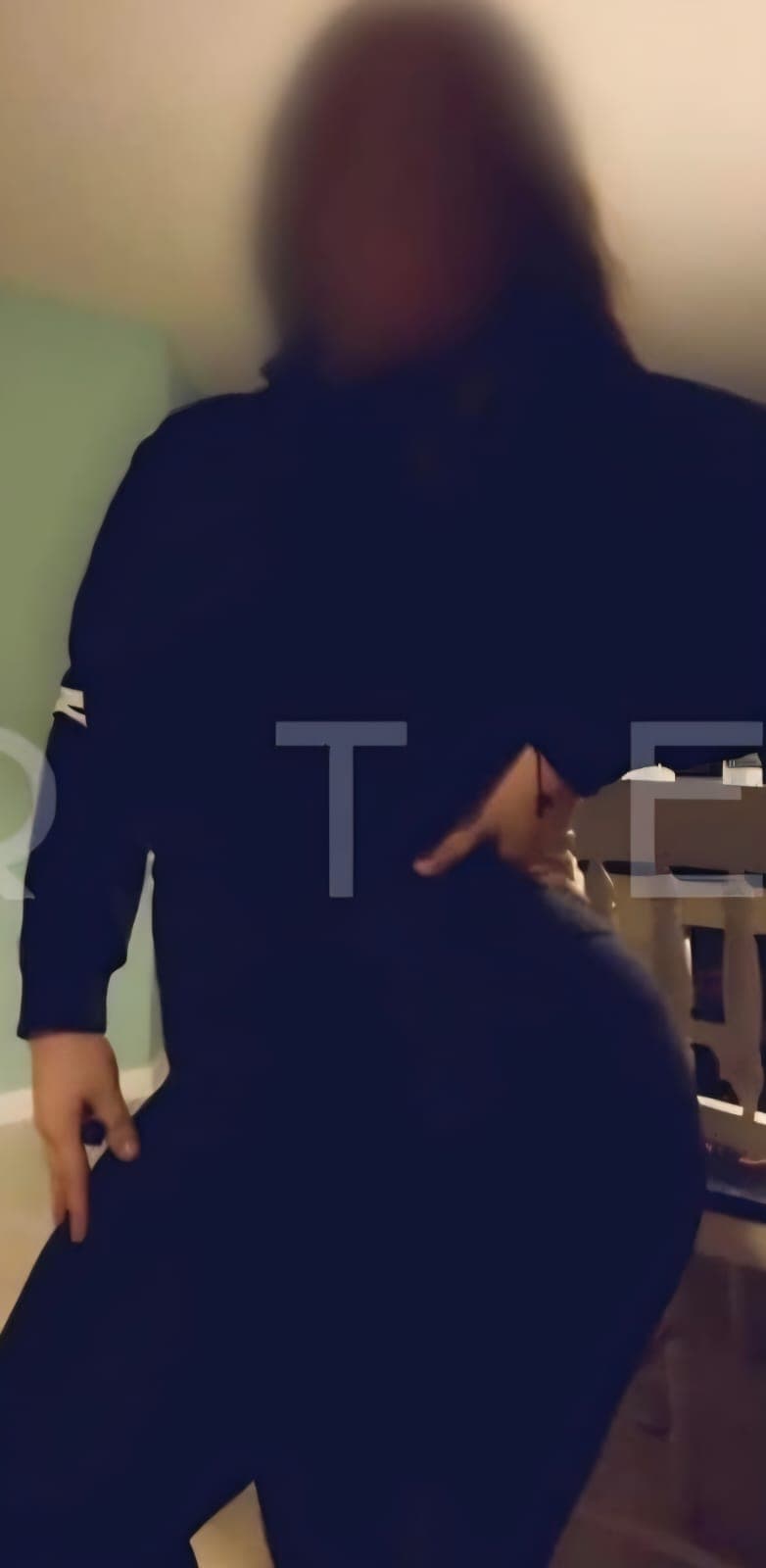 After Abdominoplastia (tummy tuck)