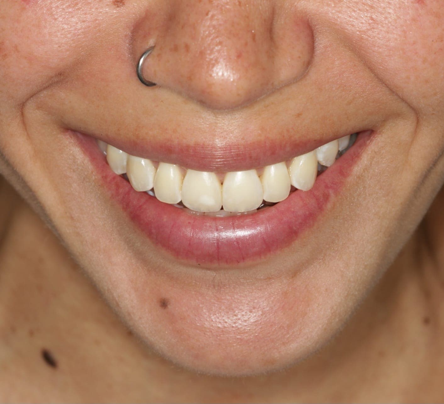 After Cirugia Ortognatica