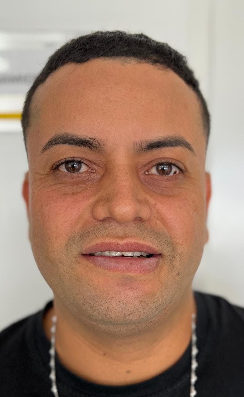 Before LENTES CERAMICOS