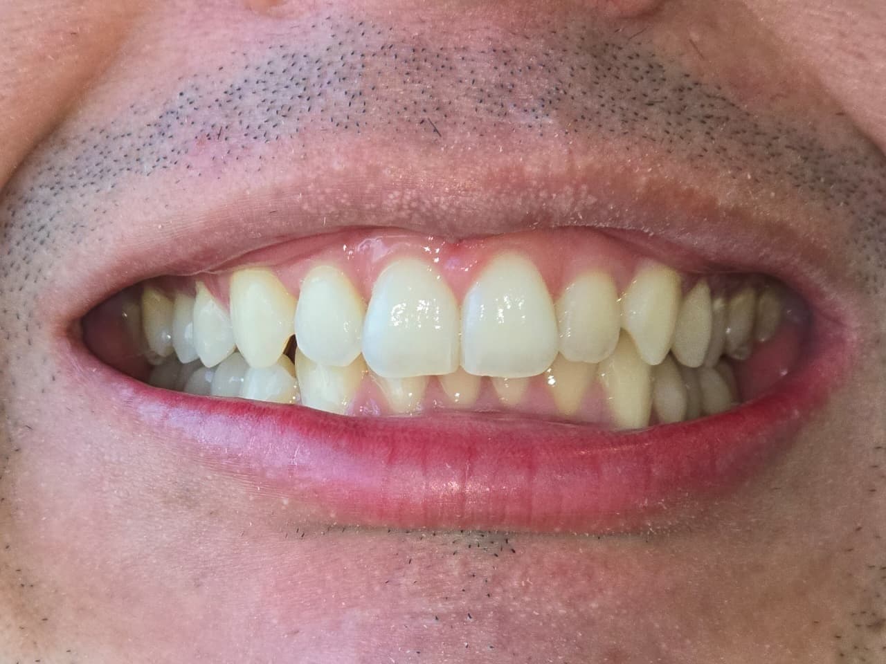 Before Microdiseño en resina de alta estética