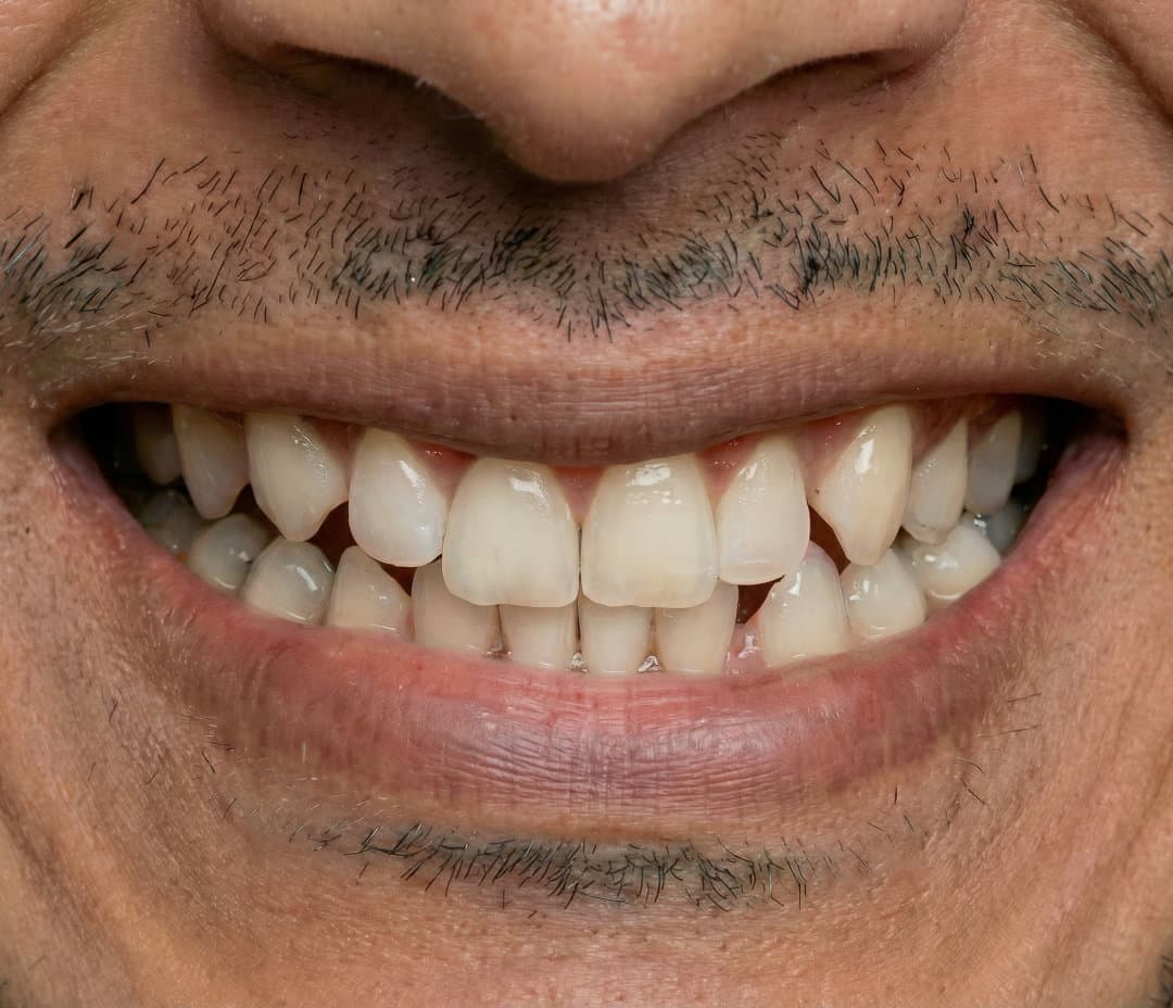 Before Invisalign y diseño de sonrisa. 1 año