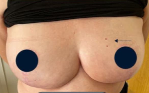 After Reduction mammaplasty