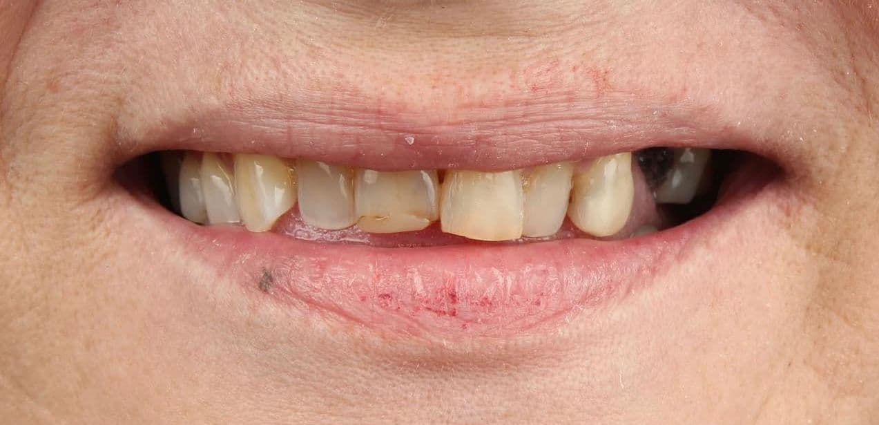 Before carillas dentales en cerámica