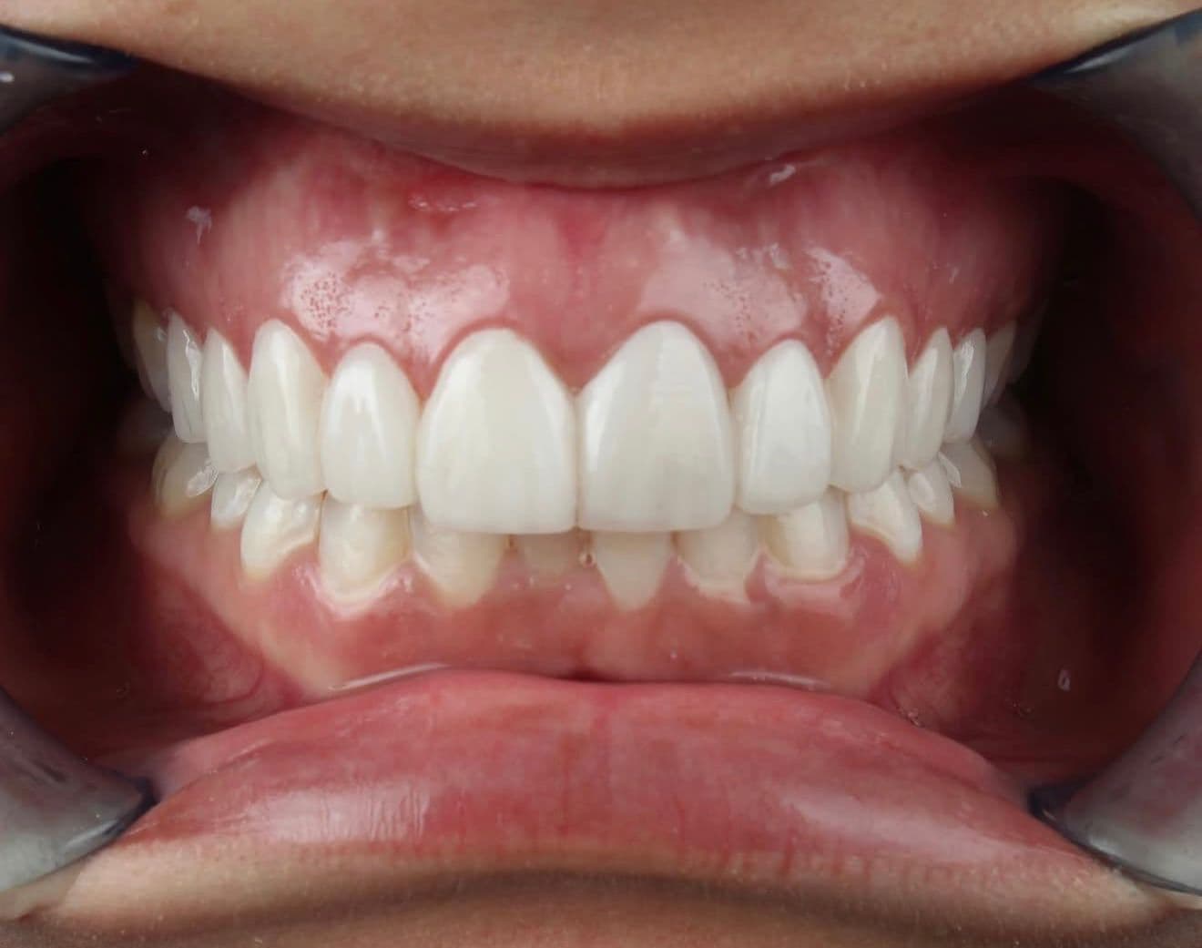 After carillas dentales en cerámica