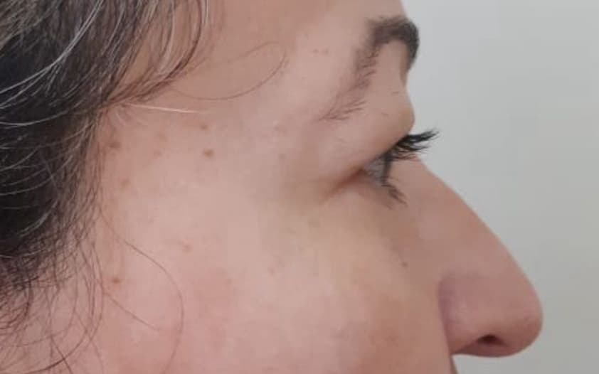 Before Blepharoplasty