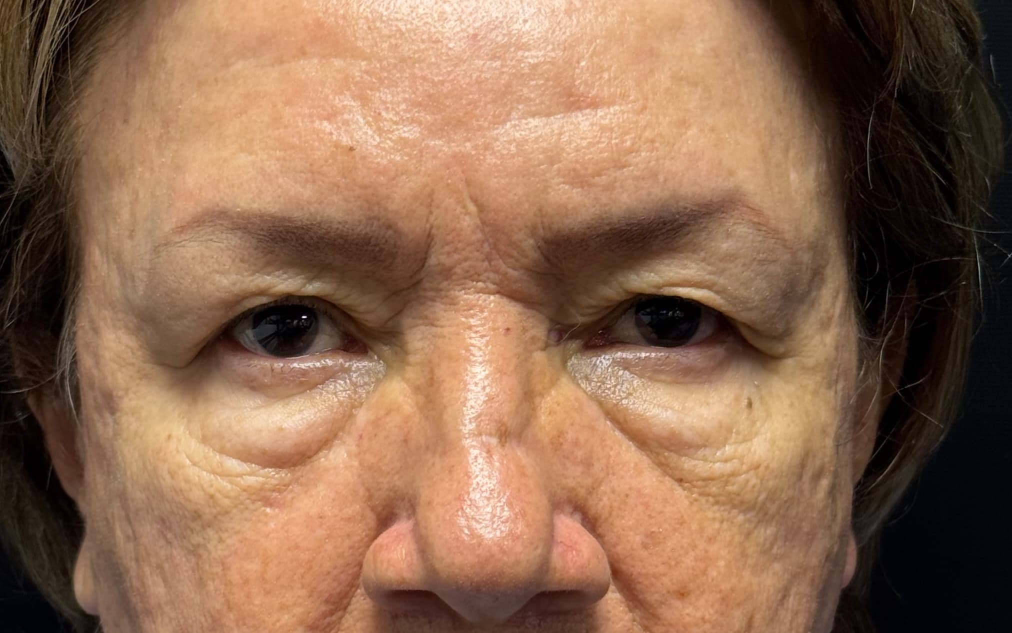 Before Blepharoplasty
