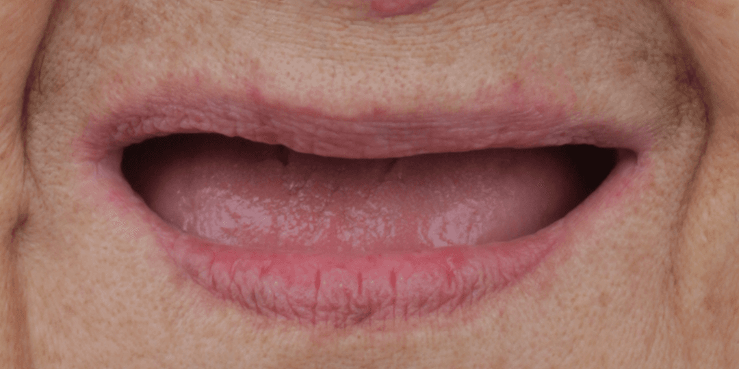 Before Prótesis híbrida Superior